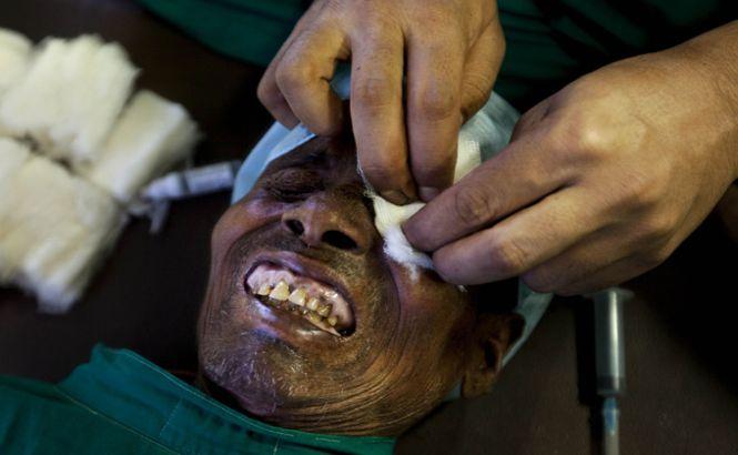 15 indieni au rămas ORBI după ce au fost operaţi GRATUIT de cataractă