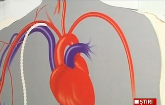 Primul implant de inimă artificială din România va fi realizat la Institutul de Boli Cardiovasculare şi Transplant din Târgu Mureş