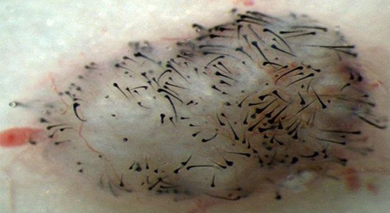 Celule stem, folosite în tratamentul căderii părului