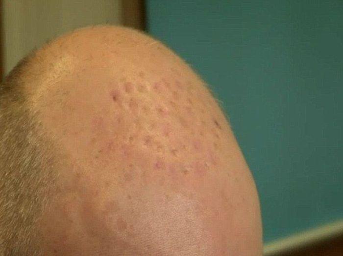 Ce i s-a întâmplat acestui bărbat după ce şi-a făcut transplat de păr: "Acum am nişte gropi în loc de păr" 293625