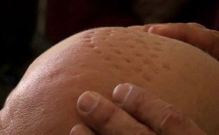 Ce i s-a întâmplat acestui bărbat după ce şi-a făcut transplat de păr: "Acum am nişte gropi în loc de păr" 293626