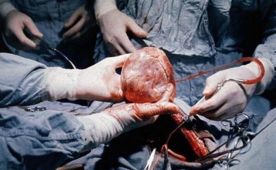 PREMIERĂ medicală în Europa: A fost realizat primul transplant reuşit al unei inimi care încetase să bată în corpul donatorului