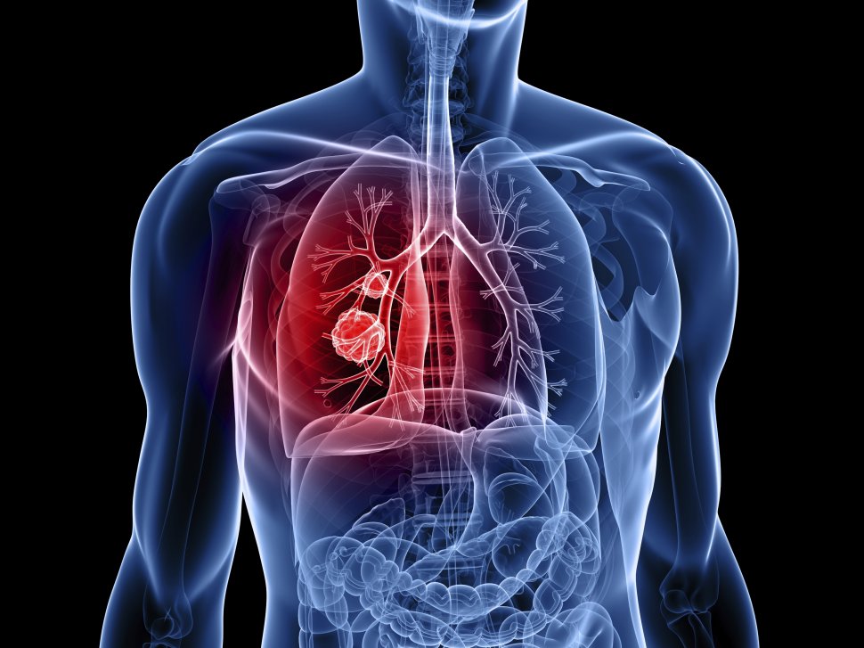 Cancer la plamani. Simptome ale cancerului pulmonar