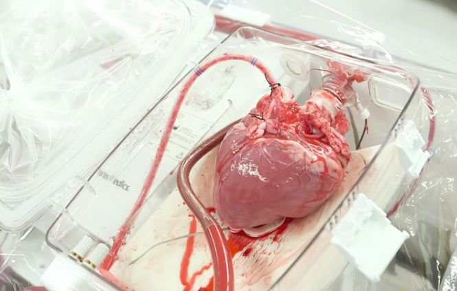 Un bărbat de 47 de ani din Neamţ a beneficiat de primul transplant de inimă din România din acest an