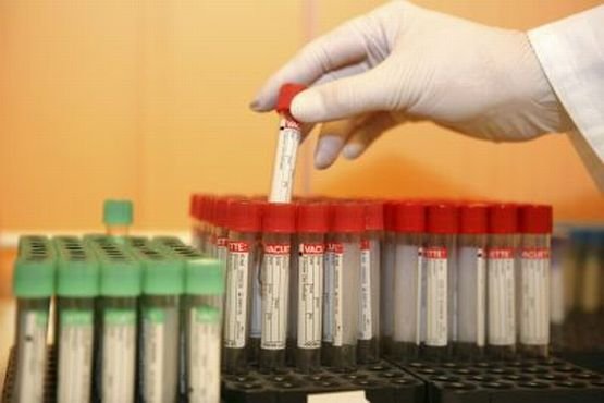 O nouă terapie anti-HIV, realizată cu anticorpi naturali, oferă rezultate promiţătoare 