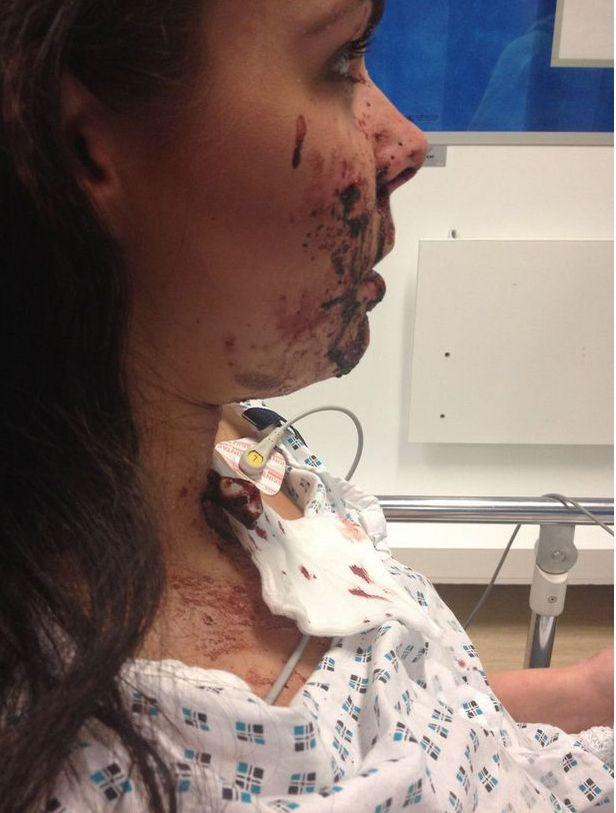 A fost DESFIGURATĂ cu sticla pentru că a oprit în mijlocul drumului! Povestea incredibilă a unei tinere dansatoare 303976