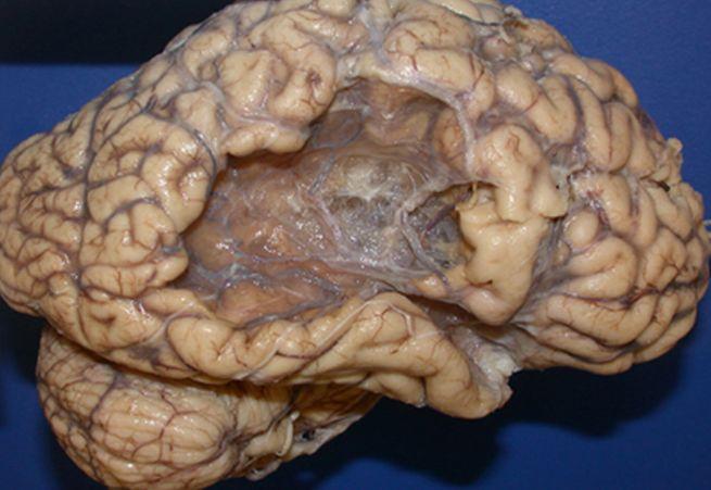 Cum arată CREIERUL UMAN după un ATAC CEREBRAL 312728