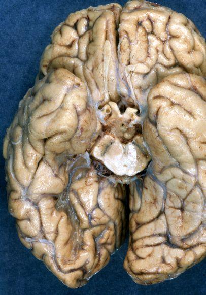 Cum arată CREIERUL UMAN după un ATAC CEREBRAL 312729