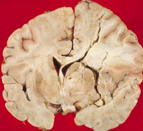 Cum arată CREIERUL UMAN după un ATAC CEREBRAL 312730