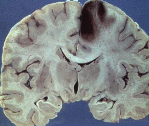 Cum arată CREIERUL UMAN după un ATAC CEREBRAL 312731