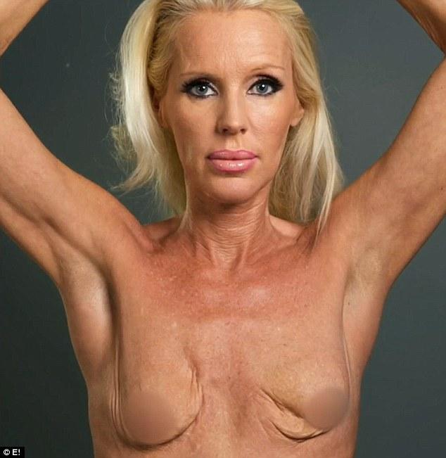 A fost la un pas de moarte din cauza silicoanelor! Cum arată acum după ce operațiile au distrus-o 315597