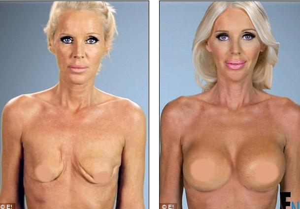 A fost la un pas de moarte din cauza silicoanelor! Cum arată acum după ce operațiile au distrus-o 315600