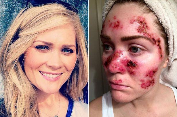 Foto ȘOCANT! Cum arată o tânără cu cancer de piele după ce a făcut o obsesie din a merge la solar 316337