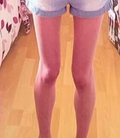 Mărturiile şocante ale unei adolescente de 14 ani care suferea de anorexie: "Mă vedeam dezgustător de grasă" - Cât a slăbit prin înfometare 319560