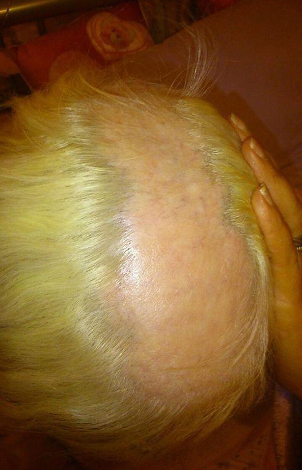 A slabit atât de mult încât a rămas și fără păr în cap. Cum arata acum femeia 323307