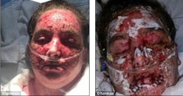 Un specialist i-a spus să facă ASTA pentru a scăpa de eczeme!  Rezultatul este oribil: "Sunt plină de cicatrici" 325383