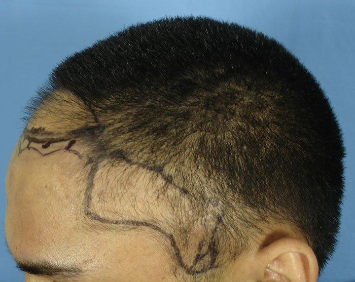 Boala gravă care poate afecta persoanele care își țin părul strâns în coadă. Imagini-avertisment publicate de medici pe internet