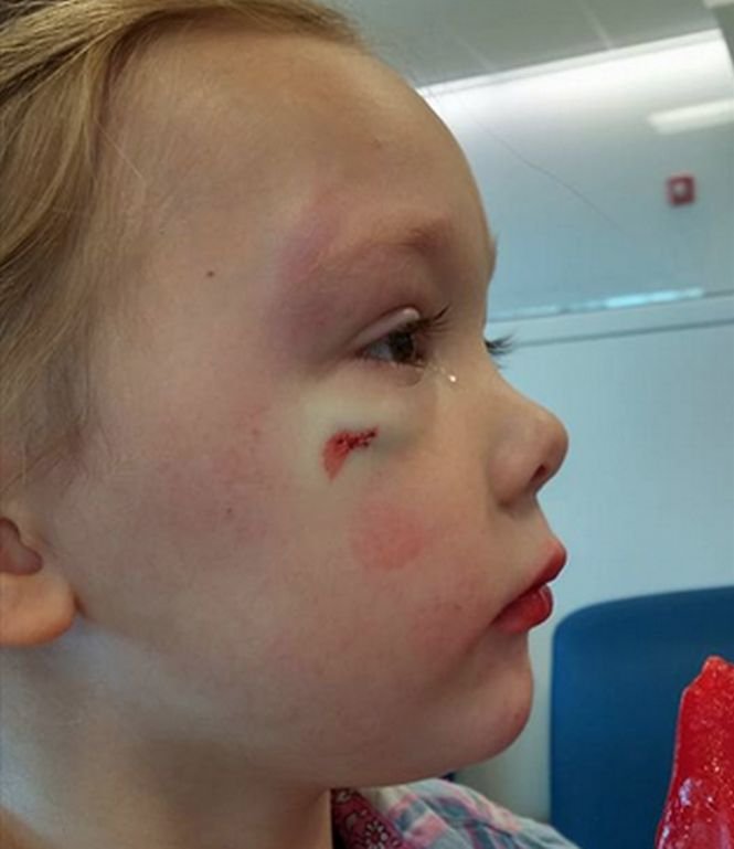 Fetiță de 4 ani lovită cu o piatră peste față. &quot;Te-a lovit pentru că te place&quot;. Reacția fermă a mamei
