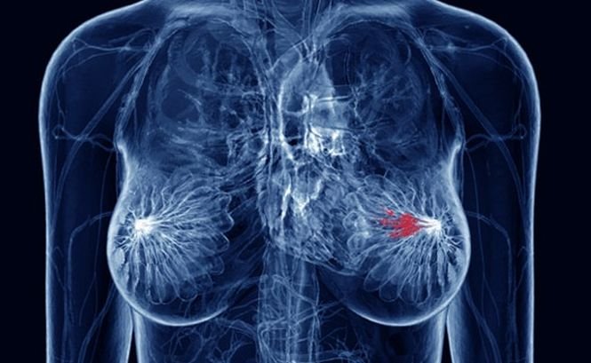Examinări medicale gratuite pentru depistarea cancerului la sân