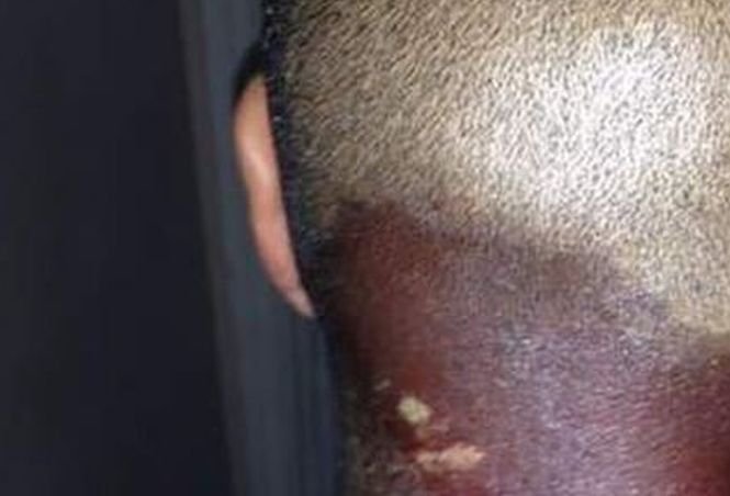Ce i s-a întâmplat unui tânăr, la câteva minute după ce a fost înţepat de un păianjen