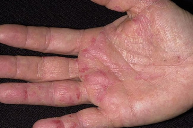 Primul semn de cancer apare pe maini! Nu il ignora