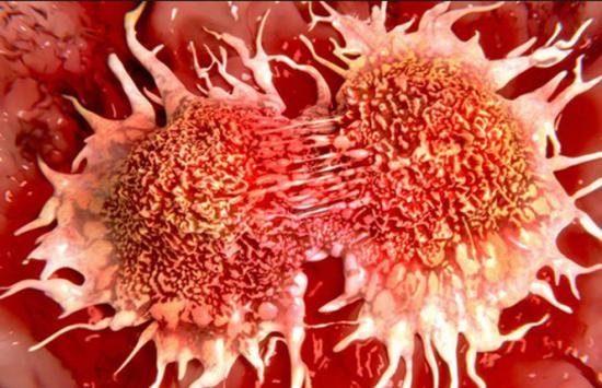 Descoperire medicală: Alimentul care ucide 85% din celulele cancerului pulmonar