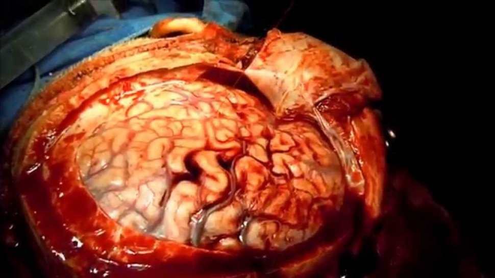 Doctorii îl operau pe creier, iar el făcea ceva extraordinar. Imagini impresionante din timpul operației