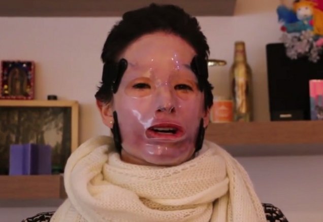 I-a fost aruncat acid sulfuric în faţă! După doi ani, femeia a avut curajul să-şi scoată masca VIDEO