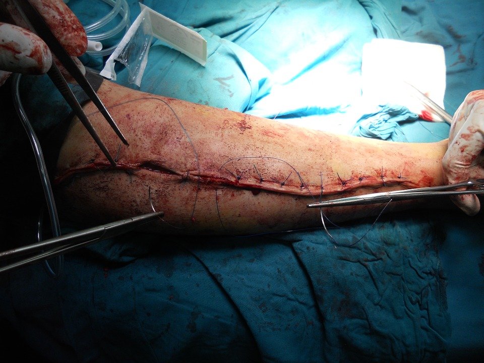 Procedura inedită prin care medicii au reușit să salveze mâna unui pacient