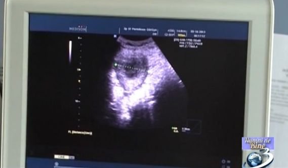 România, fruntașă la numărul de cazuri rezolvate de fibrom uterin