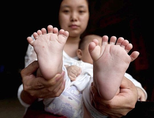 Copilul lor s-a născut cu 15 degete la mâini şi 16 la picioare