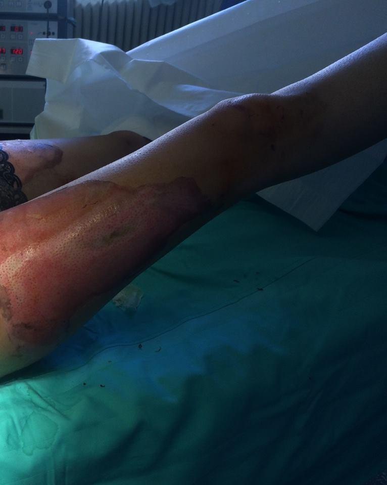 IMAGINI ȘOCANTE cu o supravieţuitoare din Colectiv. „Corupția m-a lăsat fără mâini” 387036