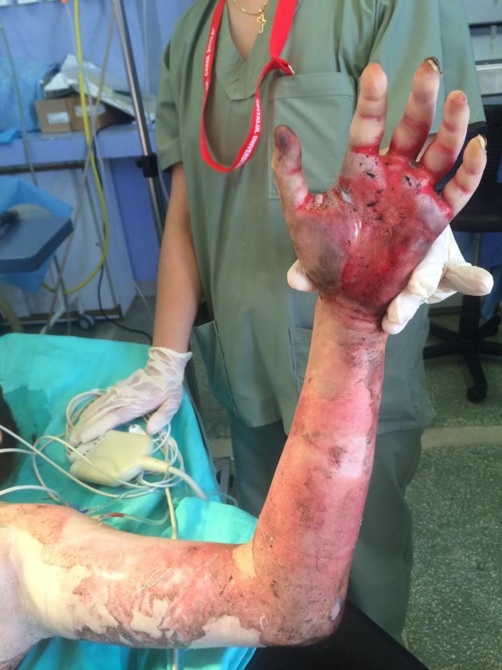 IMAGINI ȘOCANTE cu o supravieţuitoare din Colectiv. „Corupția m-a lăsat fără mâini” 387037