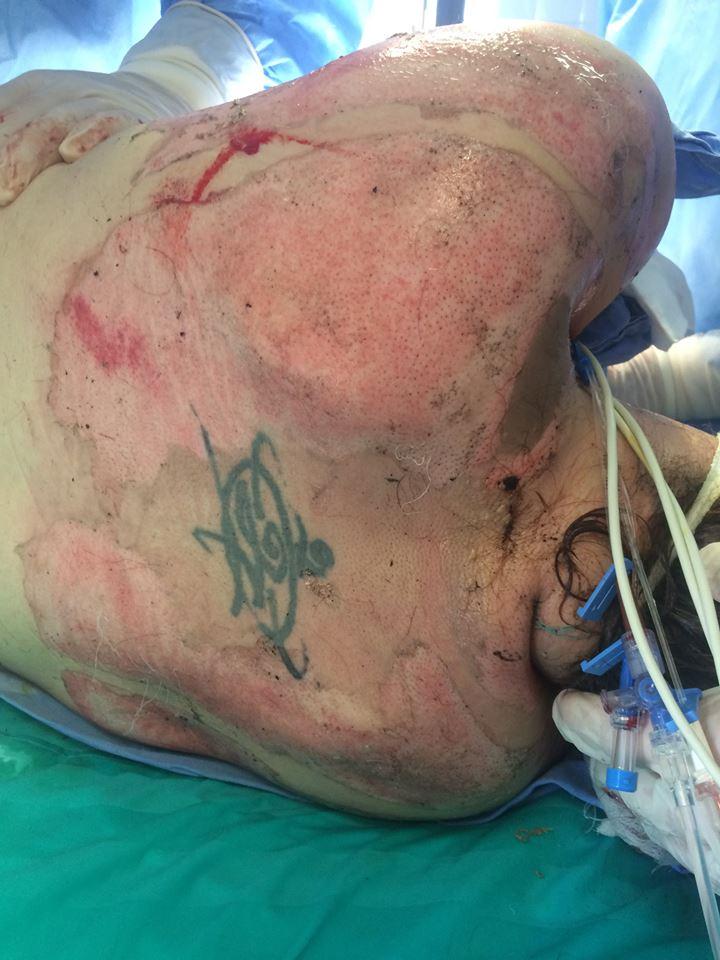 IMAGINI ȘOCANTE cu o supravieţuitoare din Colectiv. „Corupția m-a lăsat fără mâini” 387039