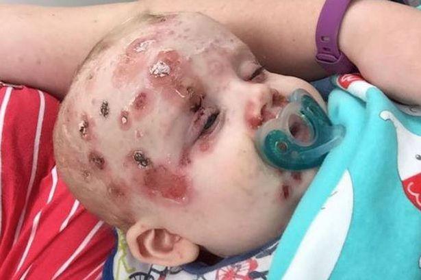 A refuzat să-și vaccineze copilul contra pojarului. După câteva zile s-a uitat la el și a început să țipe 387252