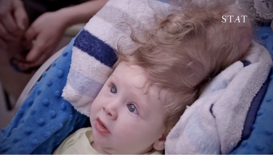 Un băiețel născut cu creierul în afara craniului uimește medicii