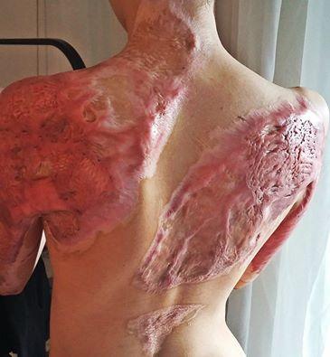 Mesajul sfâșietor al unei victime din Colectiv. Și o poză care doare. "Lumea a renunțat să mai lupte pentru însănătoșirea noastră" 397430