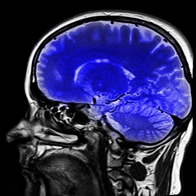 Cum arată creierul unei persoane cu mai multe kilograme în plus. Oamenii de știință trag un semnal de alarmă