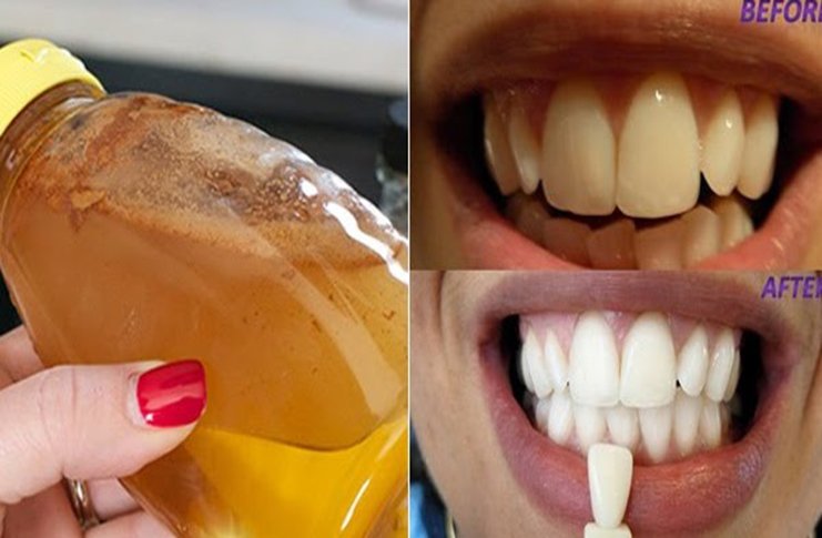 Fă gargară cu acest ingredient simplu și vezi ce lucru uimitor se întâmplă cu dinții tăi!