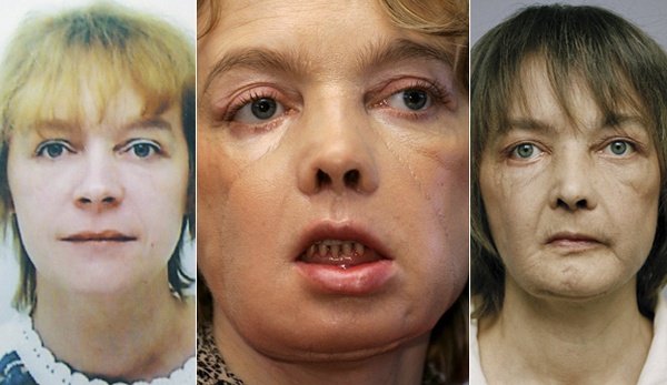 Femeia care a suferit primul transplant de față a murit