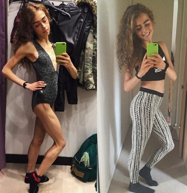 A ajuns la un pas de moarte din cauza comentariilor rautacioase! Tanara a ajuns sa cantareasca 25 de kilograme!  410950