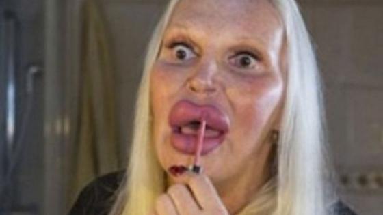 E infiorator cum a ajuns sa arate femeia asta dupa 150 de interventii la buze si pometi! Pare incredibil, dar nu vrea sa se opreasca!  411853