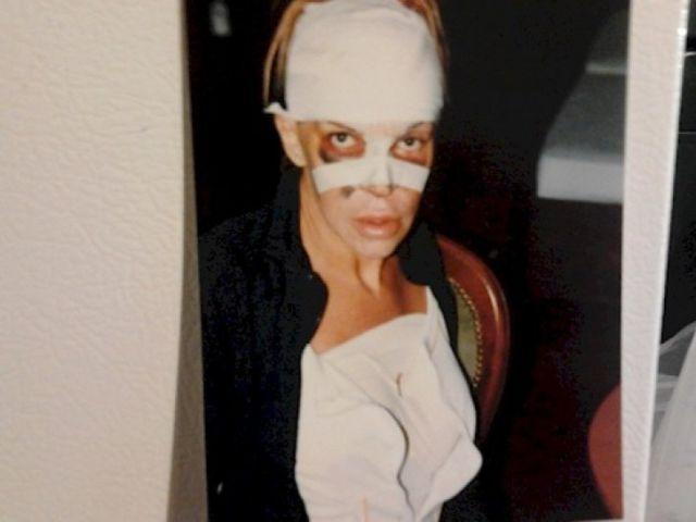 E infiorator cum a ajuns sa arate femeia asta dupa 150 de interventii la buze si pometi! Pare incredibil, dar nu vrea sa se opreasca!  411854