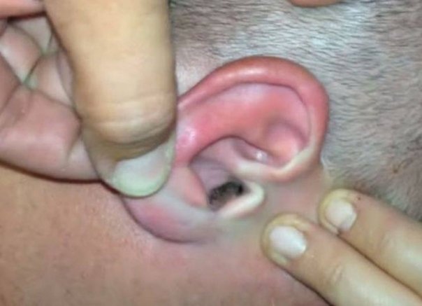 Îl mânca urechea pe interior de câteva luni și nu știa de ce. La control, doctorul s-a blocat când a văzut ce avea în ea