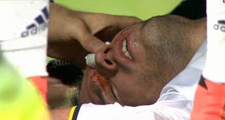 Accidentare horror pentru un cunoscut fotbalist olandez. A fost aproape să își piardă un ochi