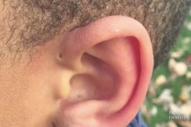 Unii oameni se nasc cu aceste mici găuri deasupra urechilor. Care este explicaţia specialiştilor