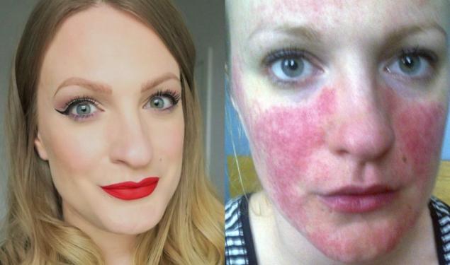 S-a trezit peste noapte cu o afecțiune oribila a pielii: "Fața mea arăta ca o roșie". Disperata, a încercat toate remediile. Nimic nu funcționa 418396
