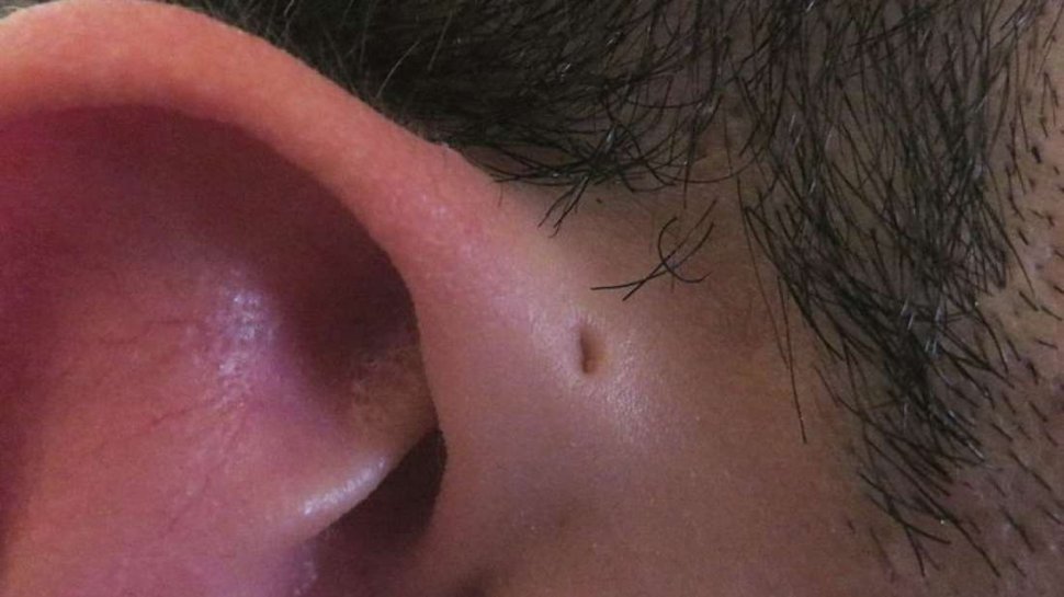 De ce unii oameni se nasc cu o gaură mică deasupra urechilor
