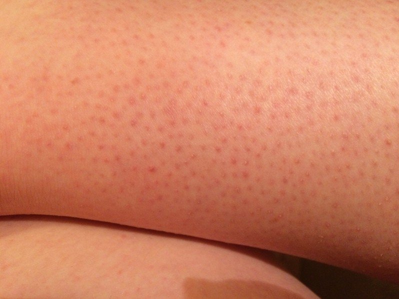 Motivul surprinzător pentru care pe pielea ta apar puncte roșii după epilatul cu lama. Este mai grav decât o simplă iritație
