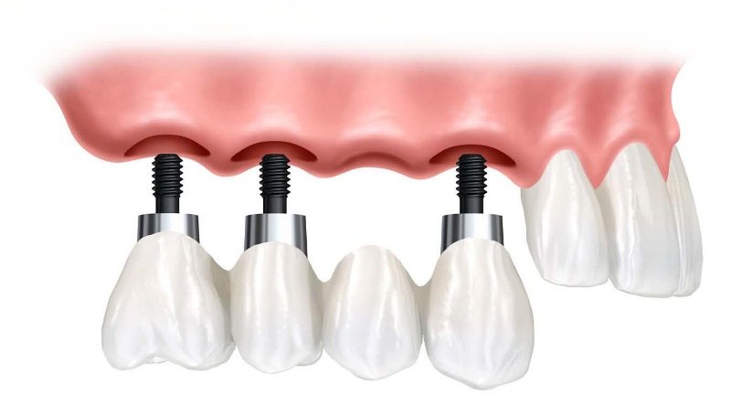 (P) 3 intrebari fundamentale ale caror raspunsuri conteaza in cazul unui implant dentar